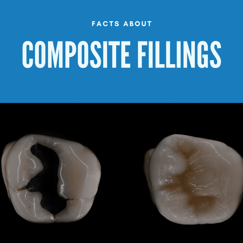 Facts About composite fillings