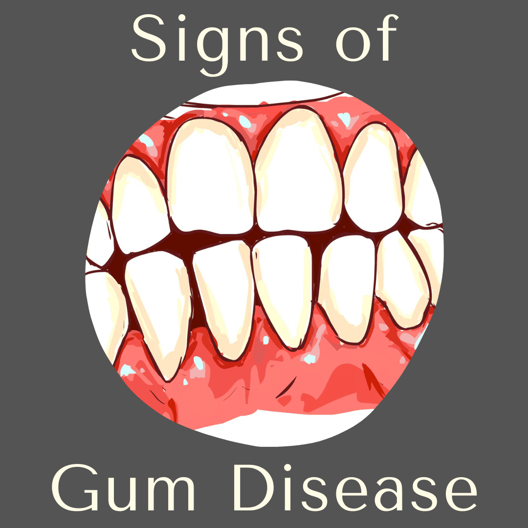 signs-of-gum-disease-channo-dds