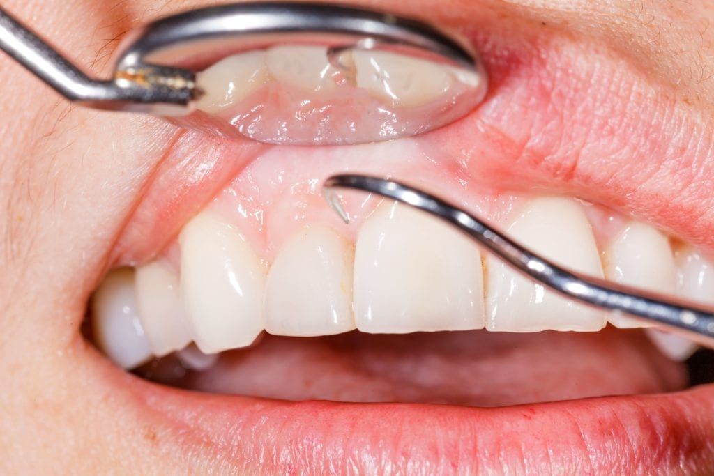dental tools examining teeth and gums
