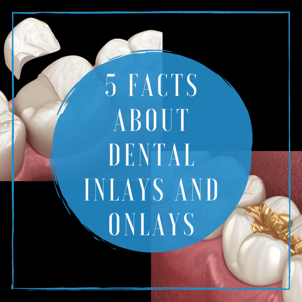 5 Facts About Dental Inlays & Onlays