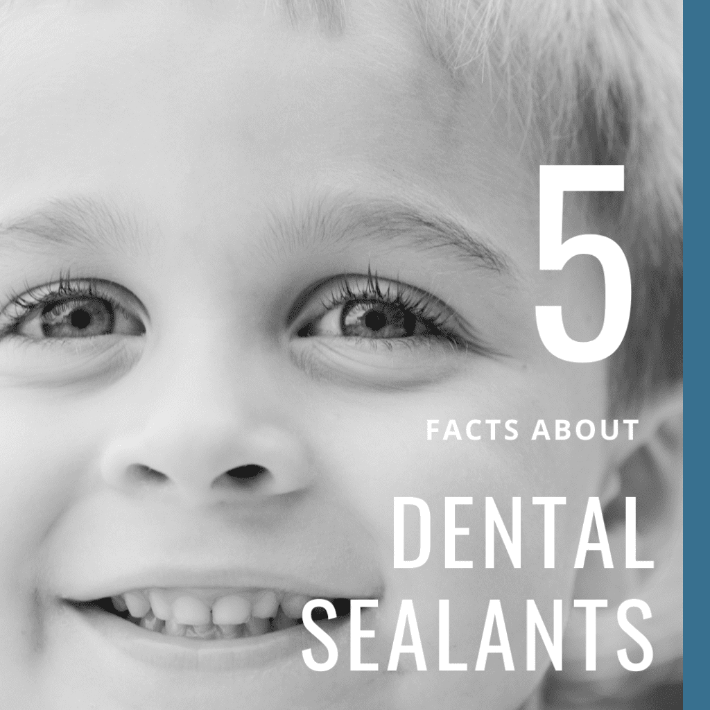 5 Facts About Dental Sealants