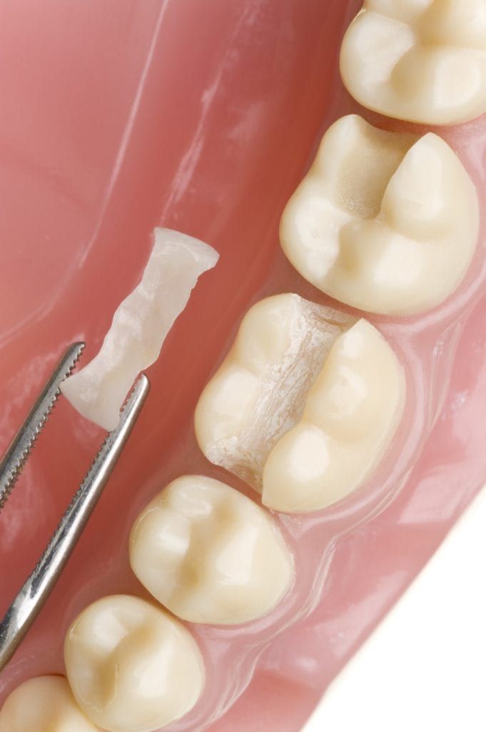 dental inlay