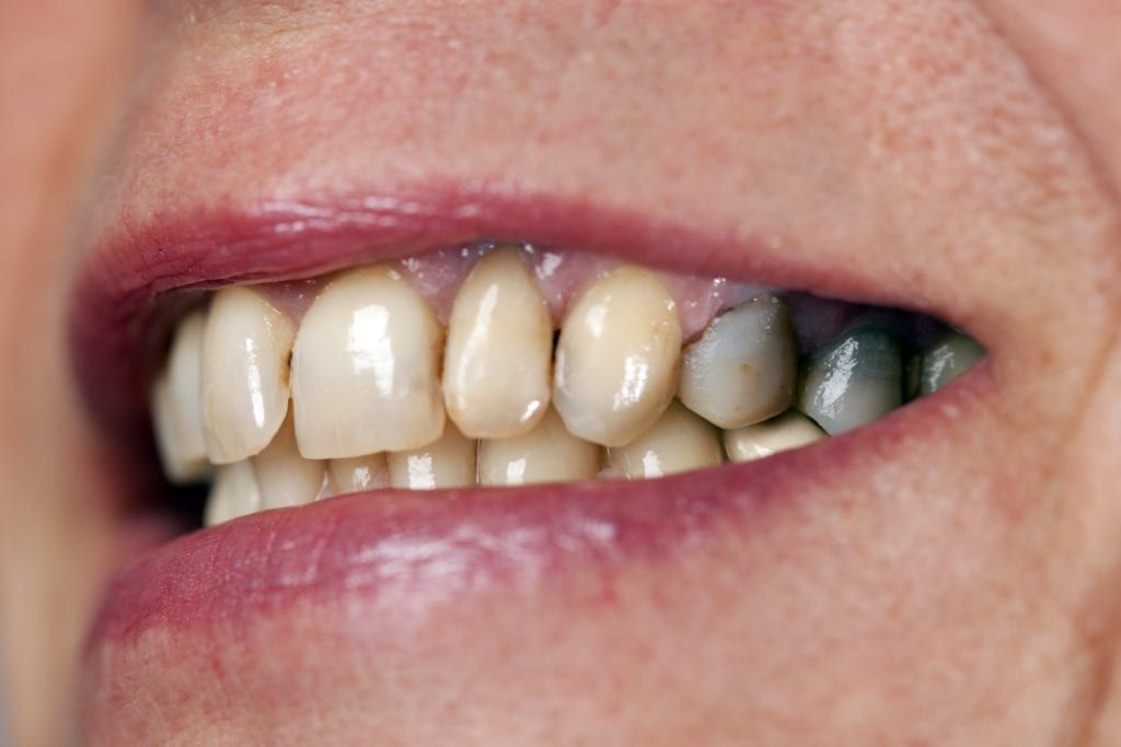 stains on teeth from amalgam filling