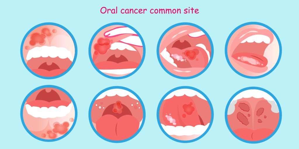 common oral cancer sites