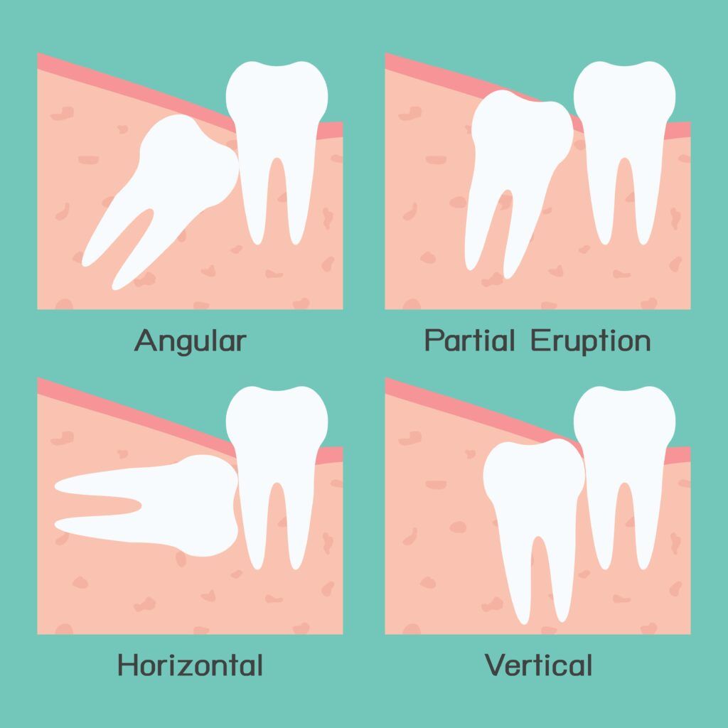 types of wisdom tooth impactions