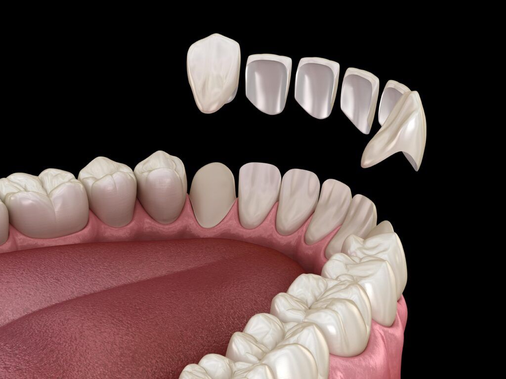 veneers on lower teeth