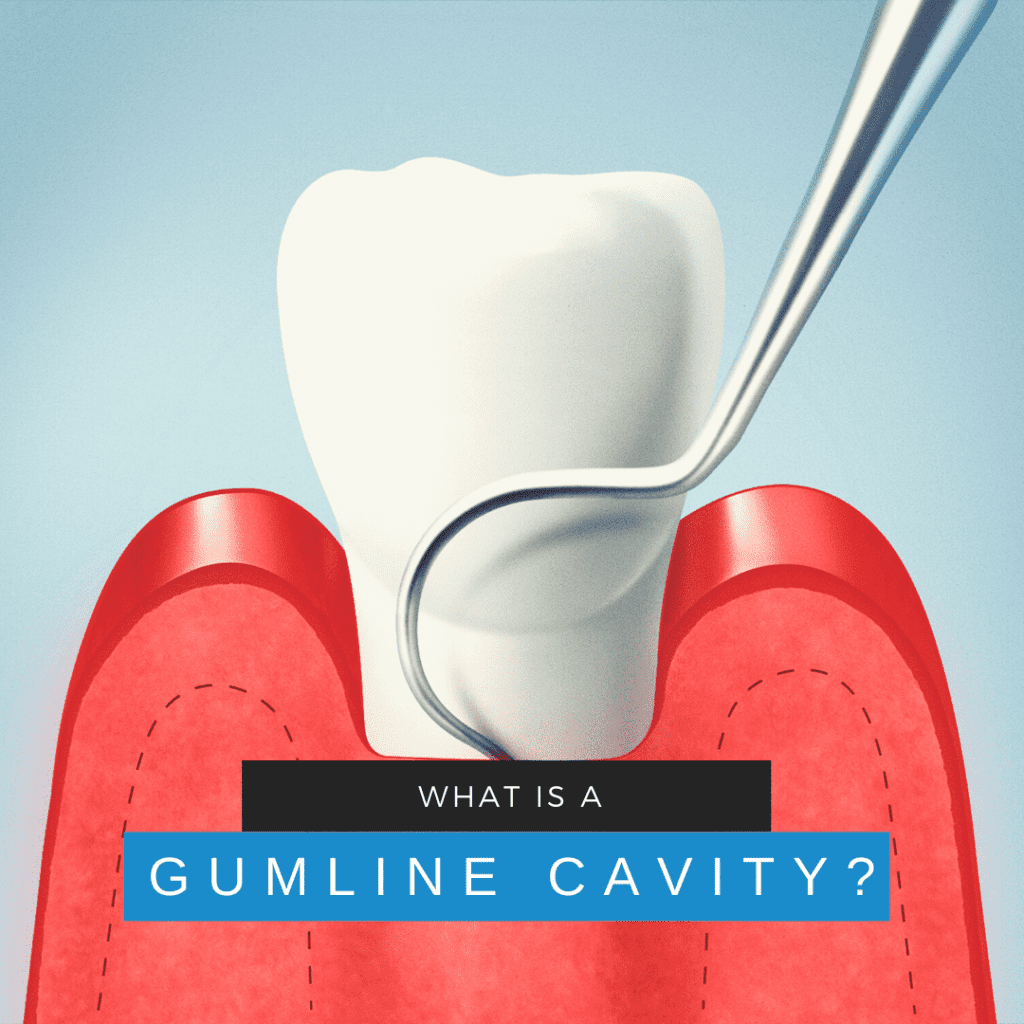 What is a gumline cavity